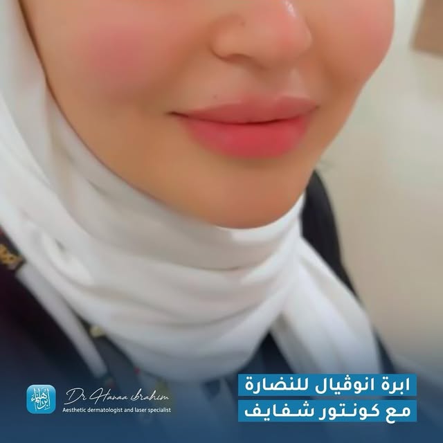 ابرة نوكليوفيل للنضارة مع كونتور الشفايف — صور قبل وبعد