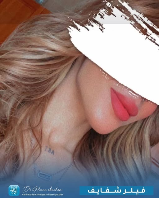 فيلر شفايف — صور قبل وبعد